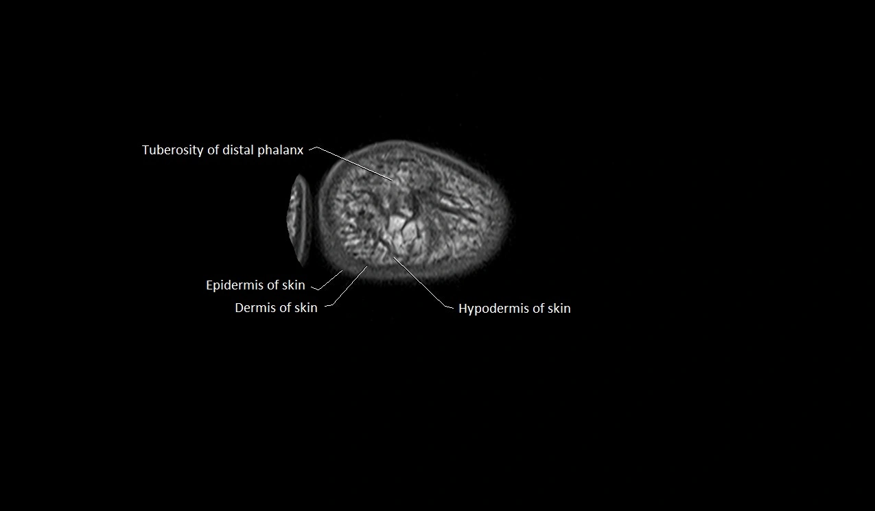 Great toe (hallux) axial microanatomy 3T MRI image 3.webp